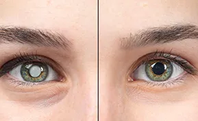 Cataract Surgery Des Plaines IL
