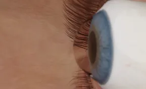 Corneal Transplant Surgeon Des Plaines IL