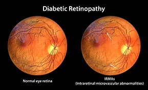 Diabetic Eye Treatment Des Plaines IL
