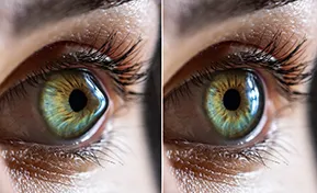 Keratoconus Doctor Des Plaines IL